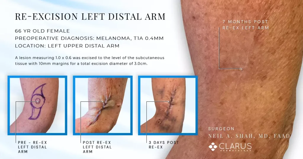 Re-excision of left distal arm before and after surgery