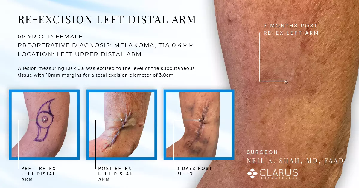 Re-excision of left distal arm before and after surgery