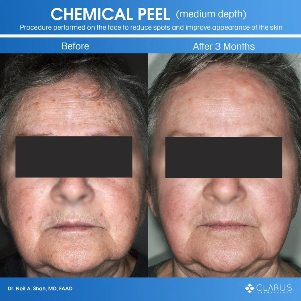Medium depth chemical peel facial treatment before and after