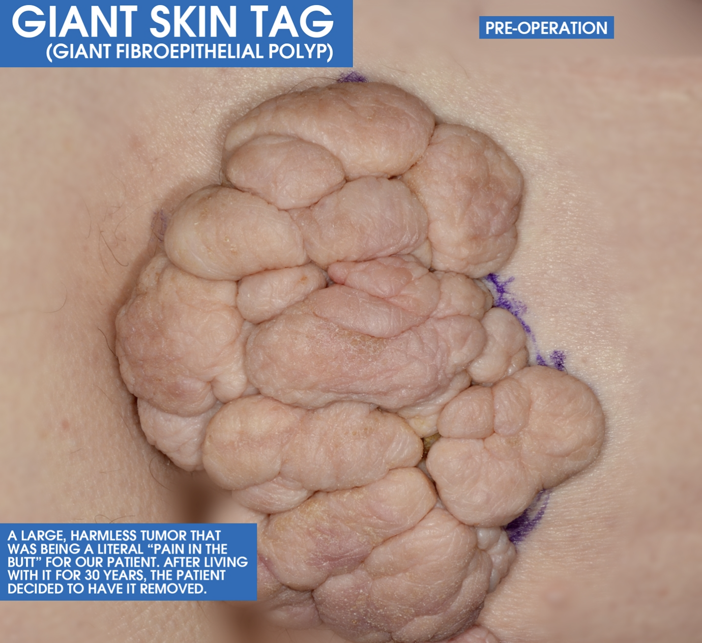 Giant skin tag before surgical removal at Clarus Dermatology