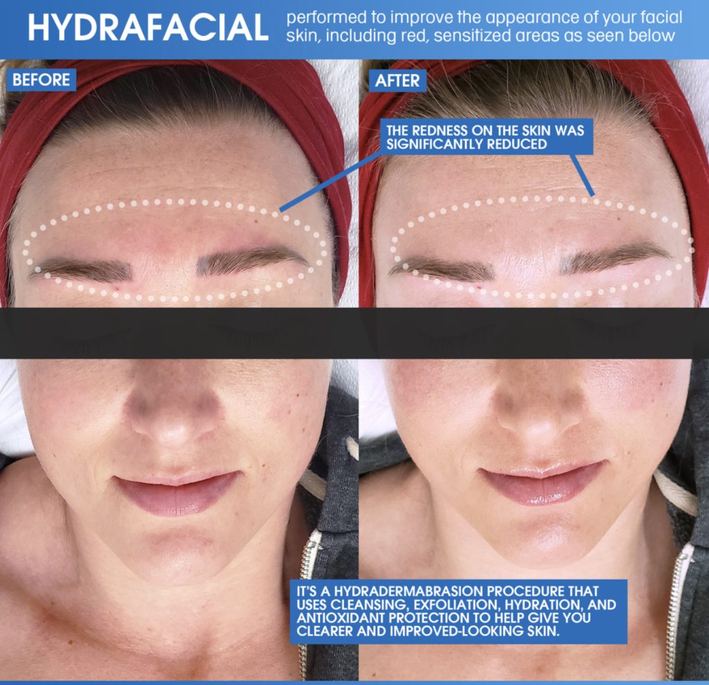 HydraFacial before and after results on red sensitized skin