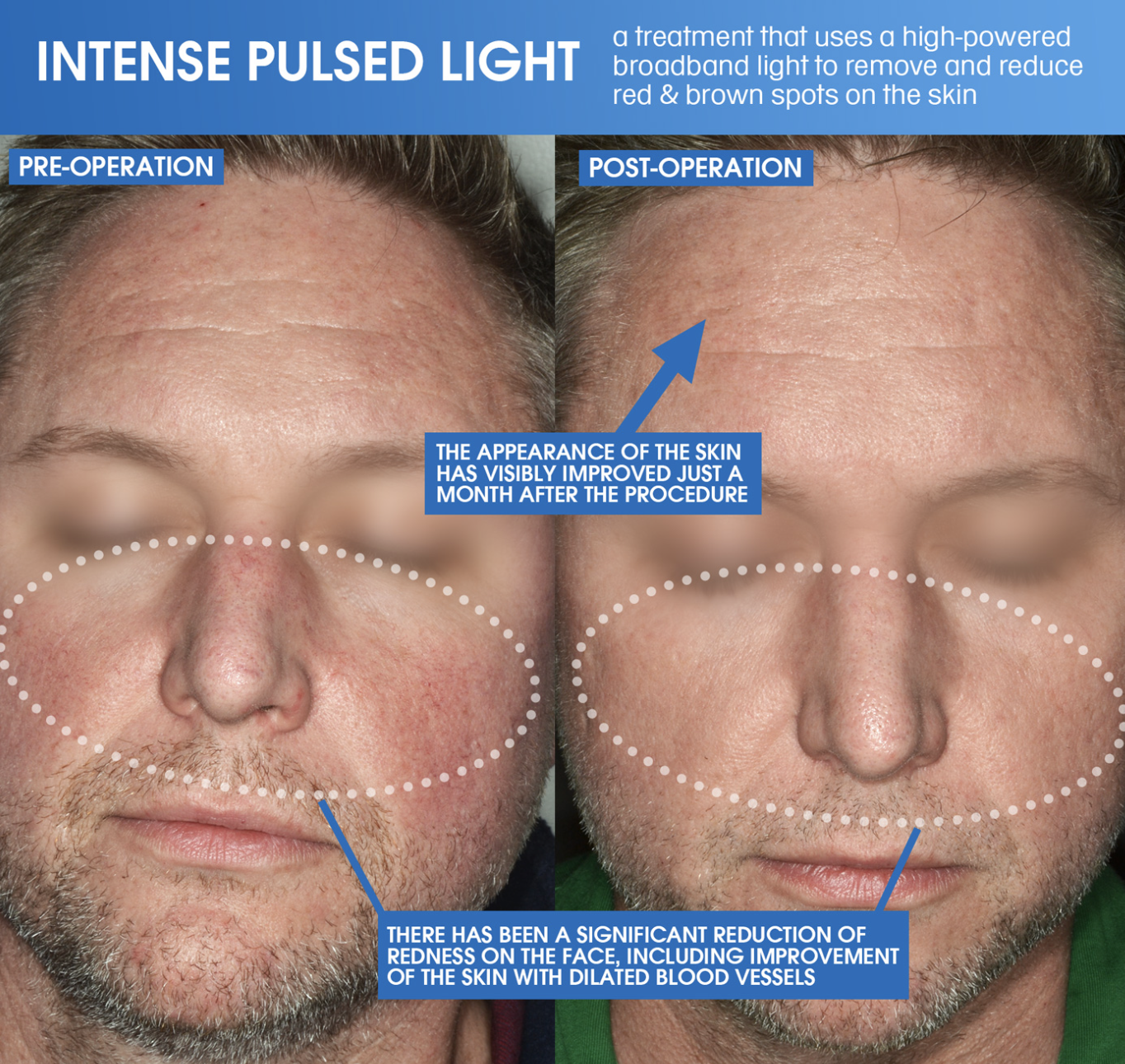 Intense pulsed light IPL treatment reducing skin redness before and after