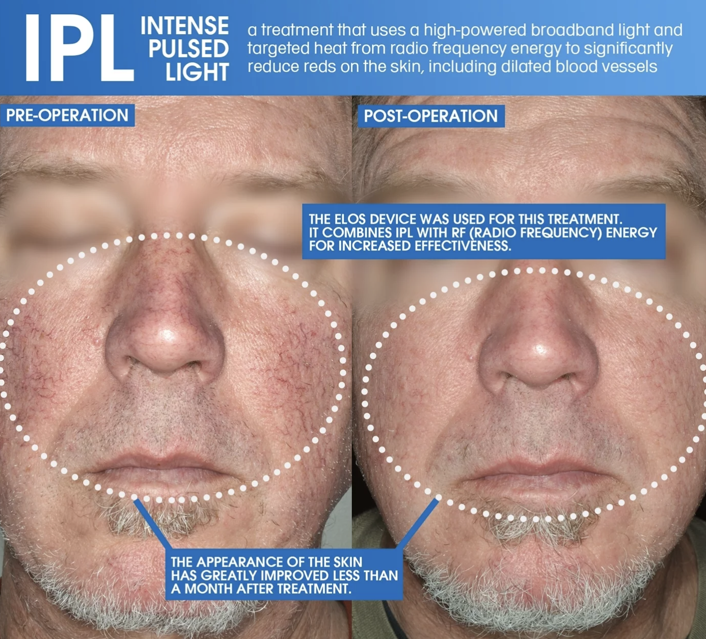 IPL and RF treatment reducing dilated blood vessels and redness