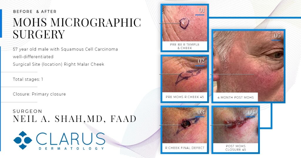 Micrographic surgery before and after showing skin cancer removal results