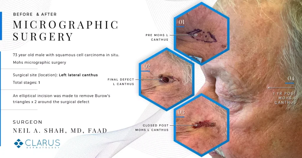 Mohs micrographic surgery before and after results