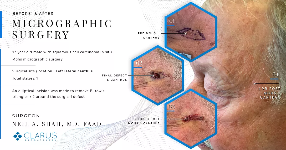 Mohs micrographic surgery before and after results