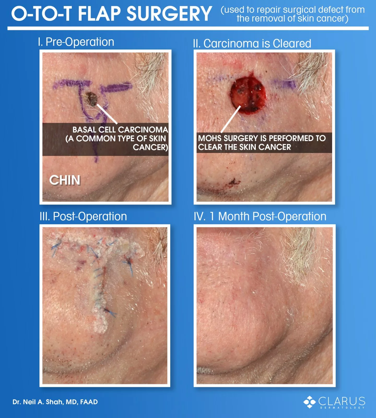 O-to-T flap surgery repairing surgical defect after skin cancer removal