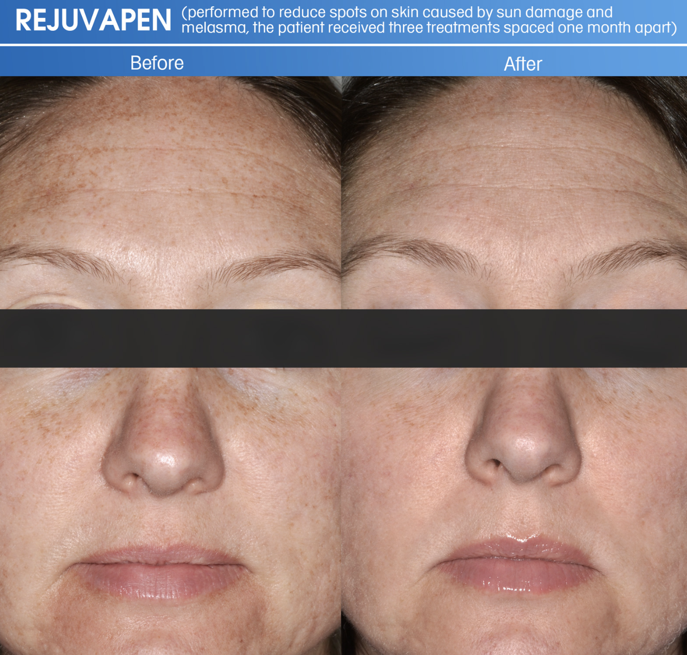 Rejuvapen microneedling for smoother firmer skin