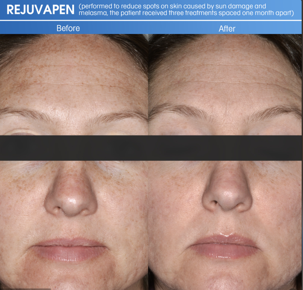 Rejuvapen microneedling treatment for sun-damaged skin at Clarus Dermatology
