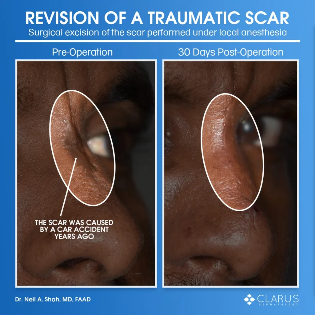 Scar revision on nose after car accident at Clarus Dermatology