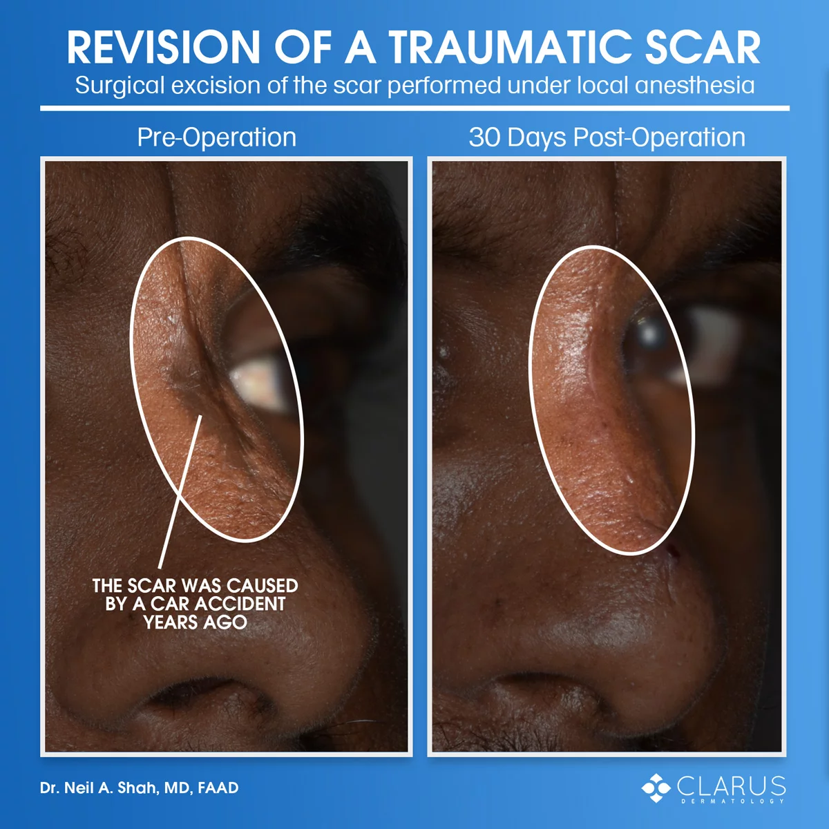 Scar revision on nose after car accident at Clarus Dermatology