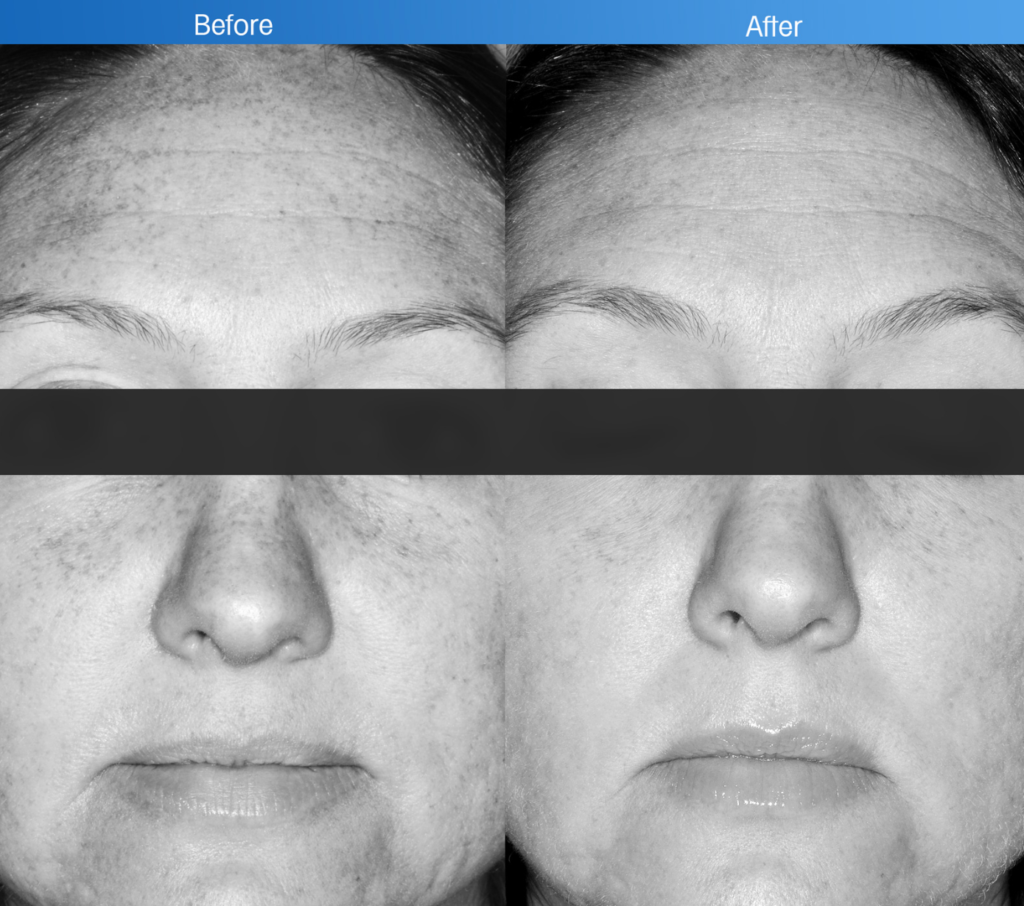 Patch testing for allergic contact dermatitis