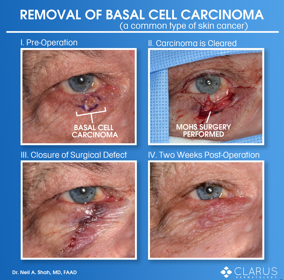 Basal cell carcinoma removal from patient eyelid before and after