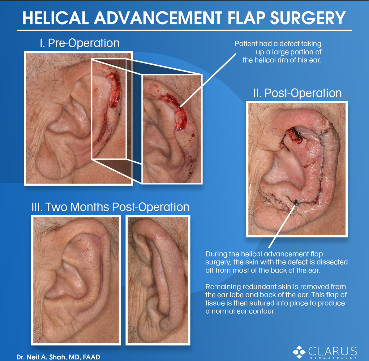 Helical advancement flap surgery results on the ear