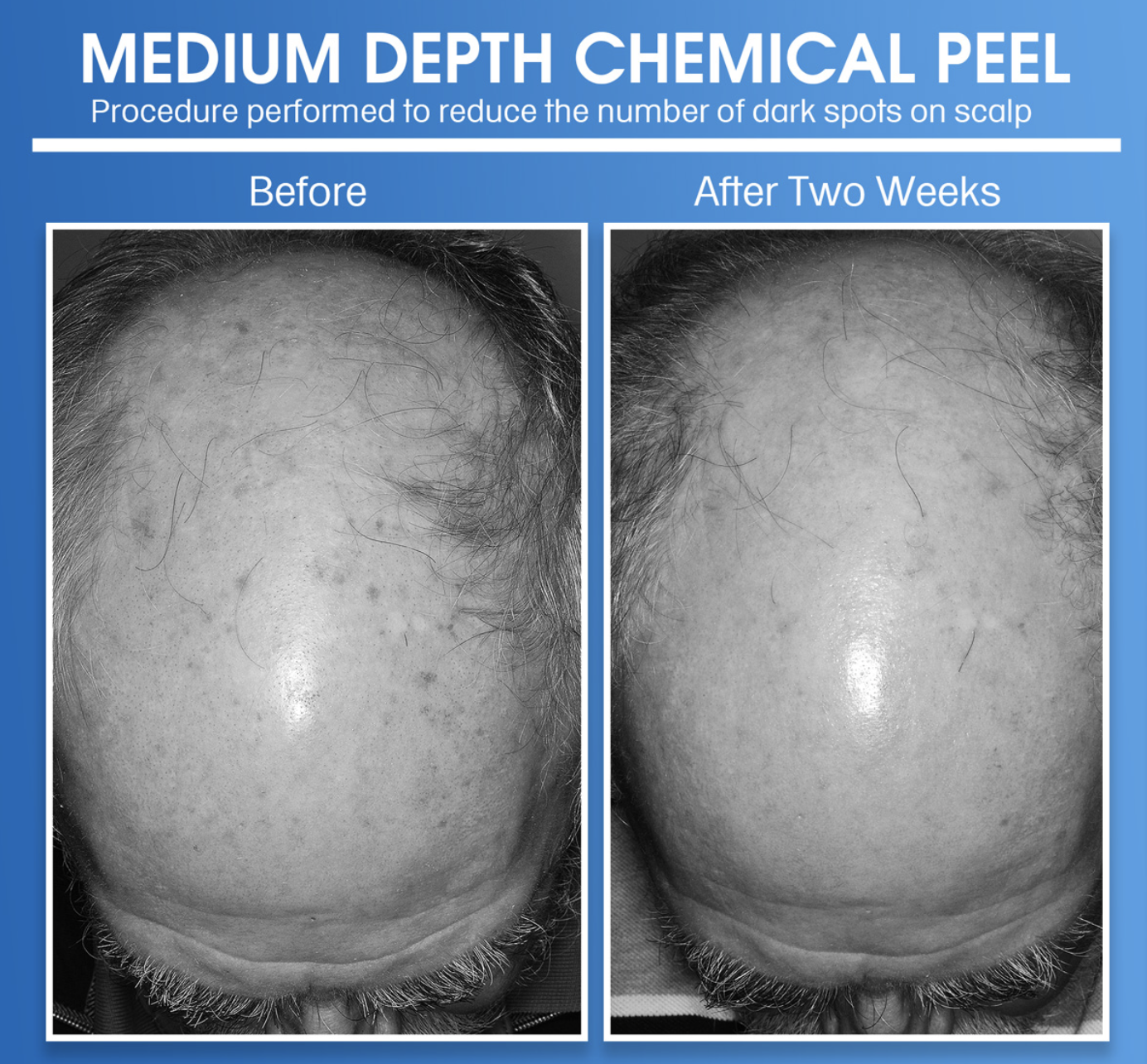 Medium depth chemical peel treatment on the scalp