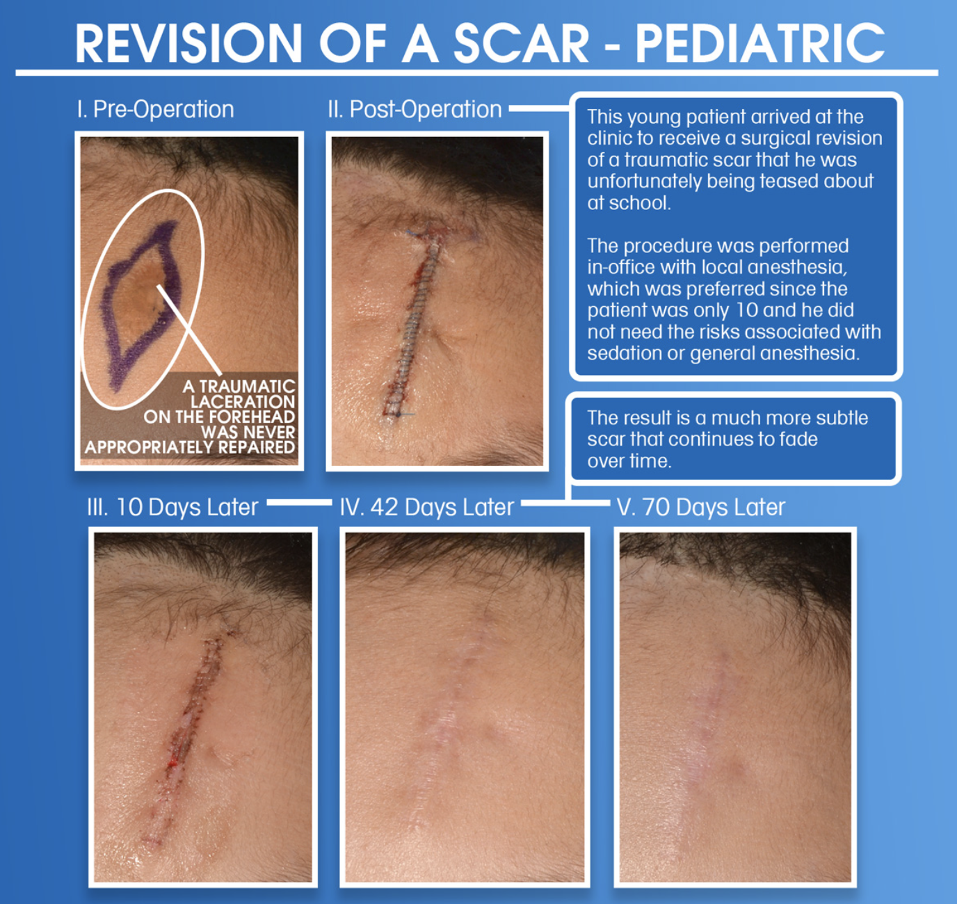 Surgical scar revision on a pediatric patient