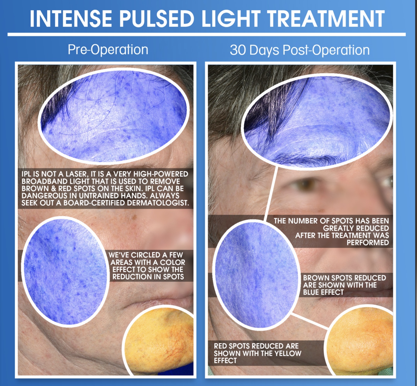 Intense pulsed light IPL treatment reducing facial spots before and after