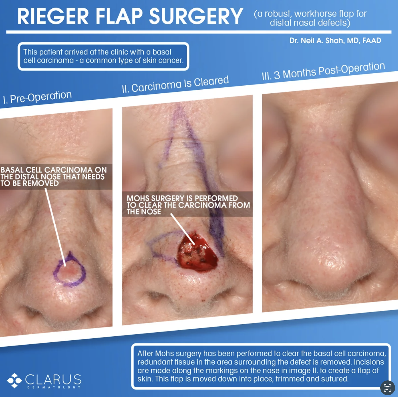 Rieger flap surgery reconstruction results