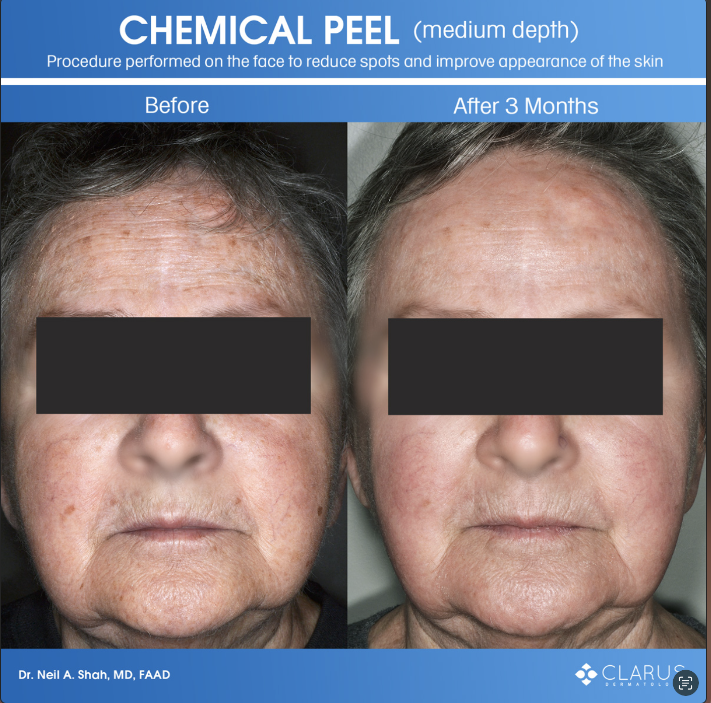 Chemical peel on face reducing spots and improving skin appearance