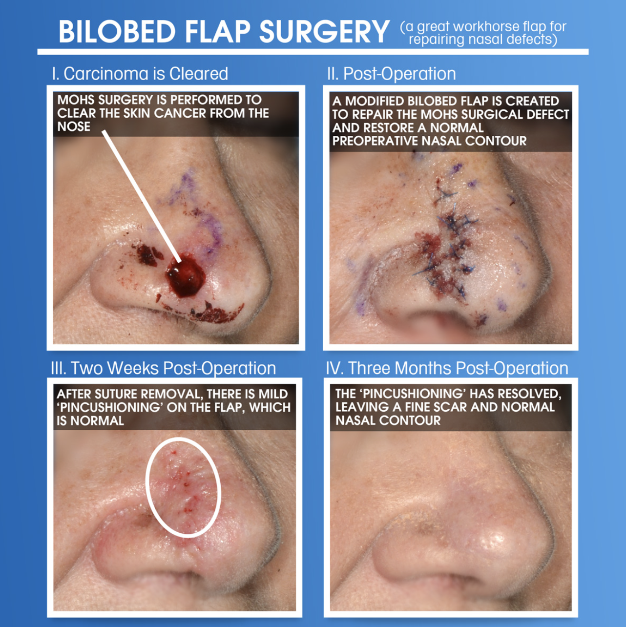 Bilobed flap surgery reconstructing nose contour after skin cancer removal
