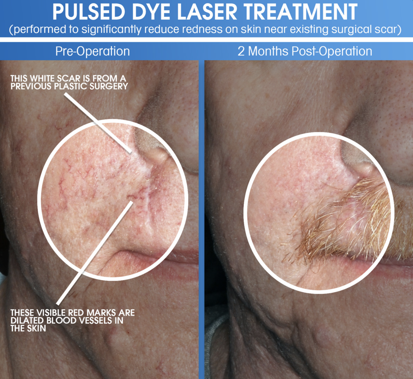 Pulsed dye laser treatment reducing facial redness before and after