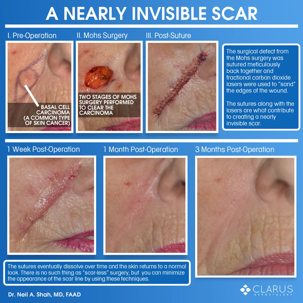 Nearly invisible scar created using advanced surgical techniques
