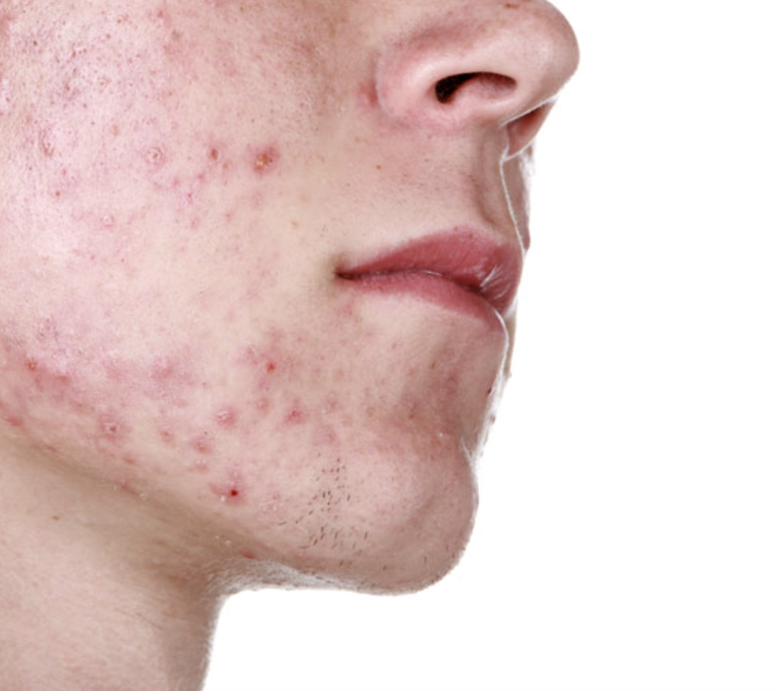 Acne and scarring dermatology treatment in Minneapolis