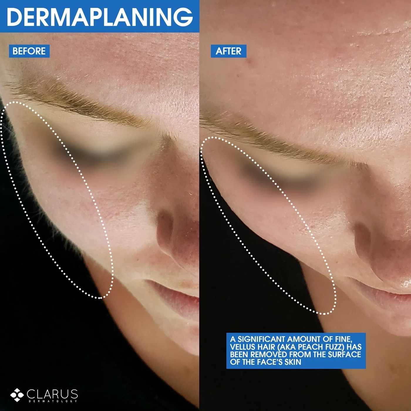Dermaplaning before and after results at Clarus Dermatology