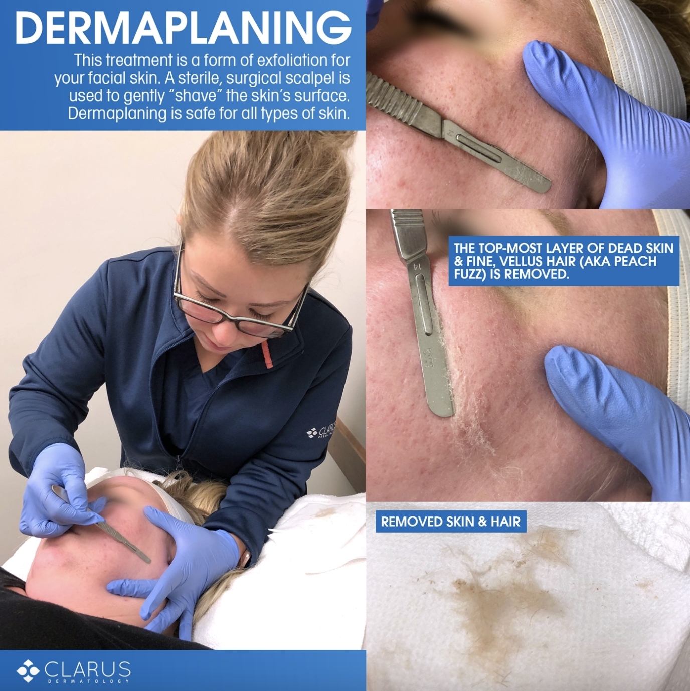 Dermaplaning procedure removing dead skin and peach fuzz