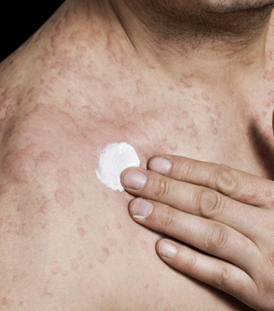 Eczema skin condition during awareness month