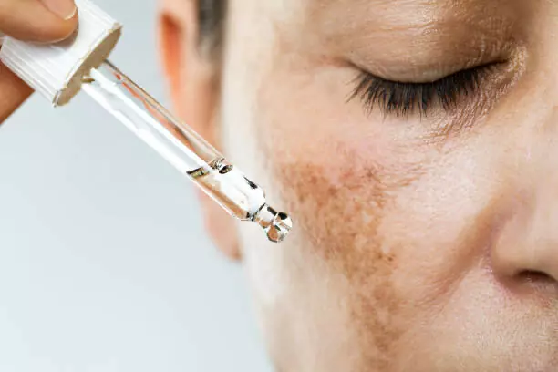 Melasma hyperpigmentation skin condition close-up