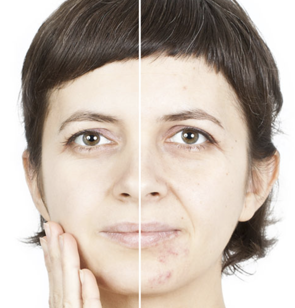 TCA peel treatment showing medium depth chemical peel results