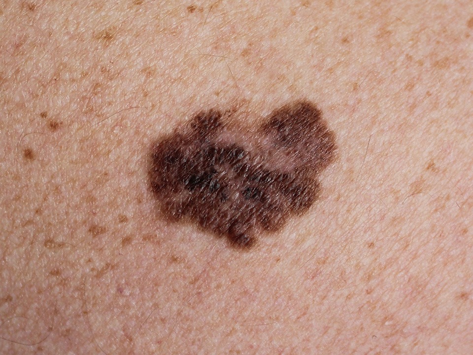 Melanoma skin cancer awareness and facts