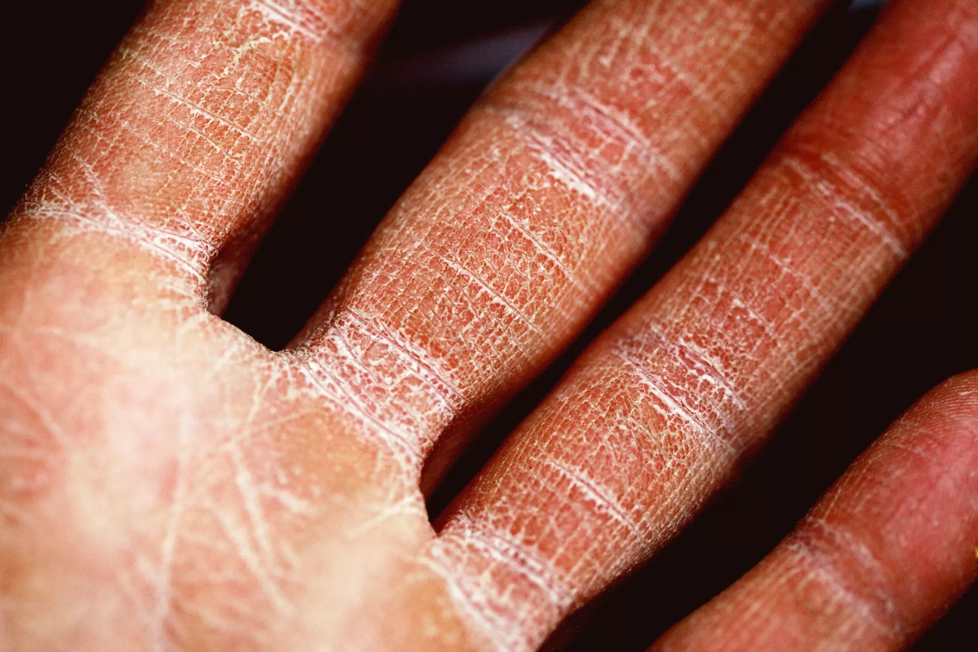 Psoriasis and eczema treatment tips for cold weather
