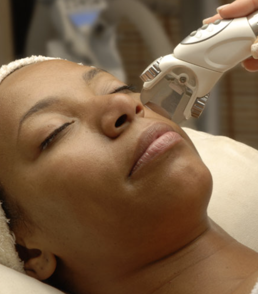 Laser skin resurfacing treatment in Minneapolis