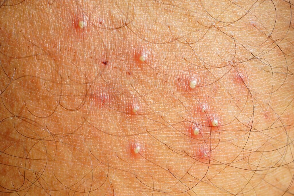 Folliculitis vs ingrown hairs red bumps treatment guide