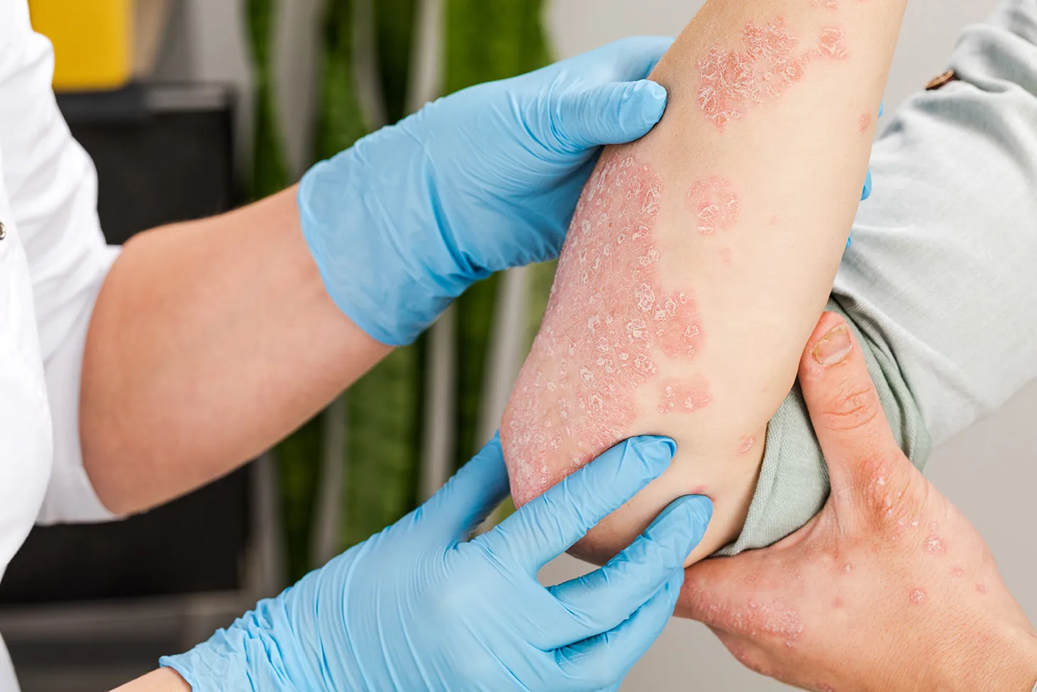 Eczema and dermatitis treatment providing skin relief