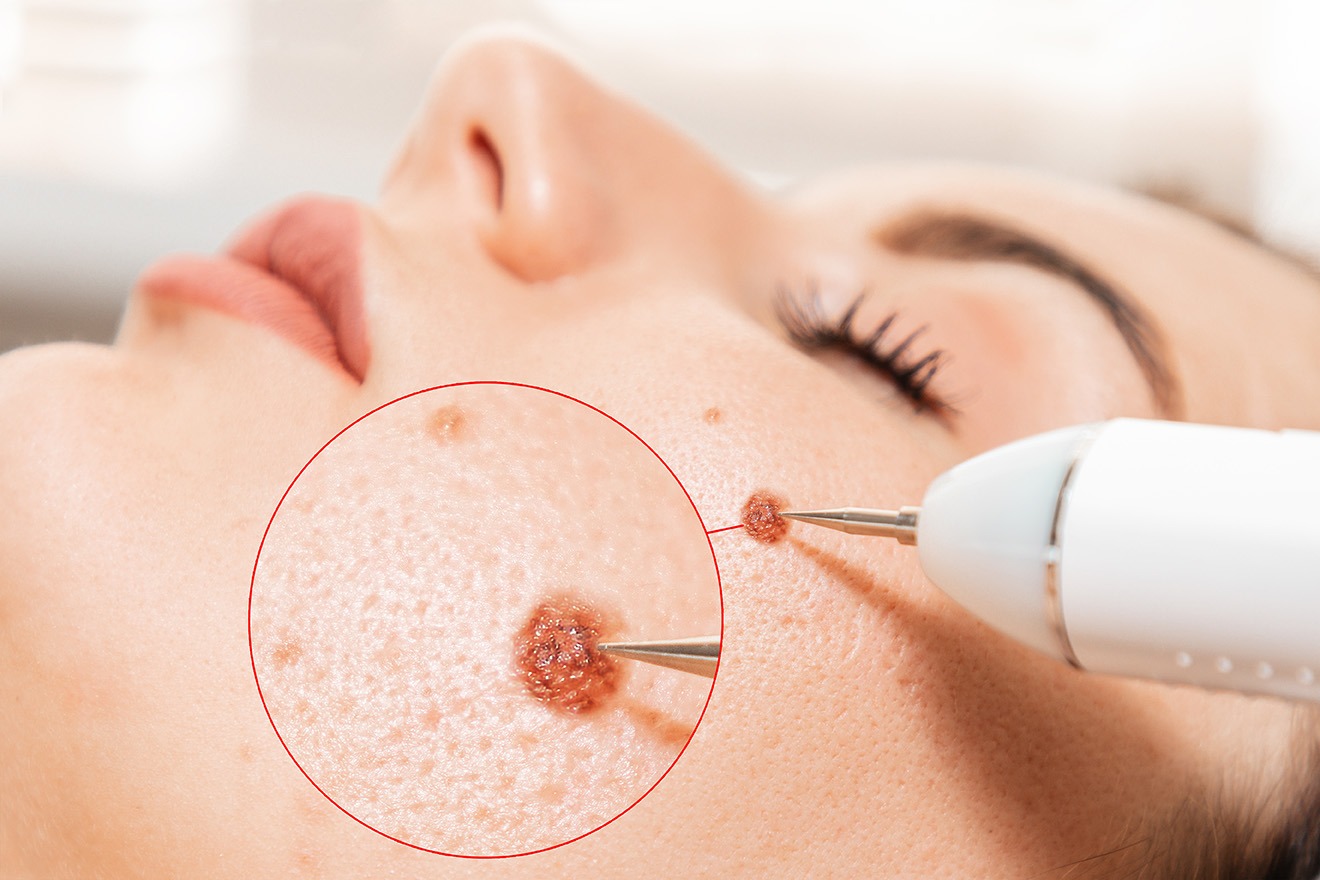 Patient choosing self-pay for mole removal procedure