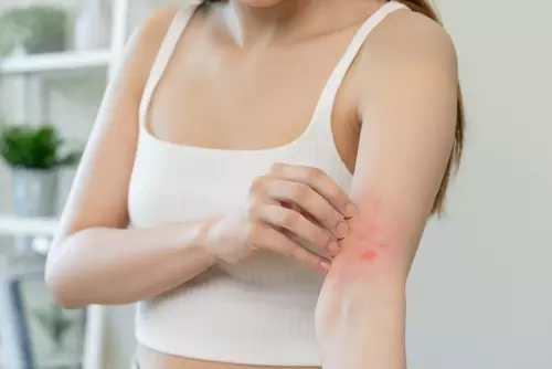 Eczema skin condition showing causes and symptoms