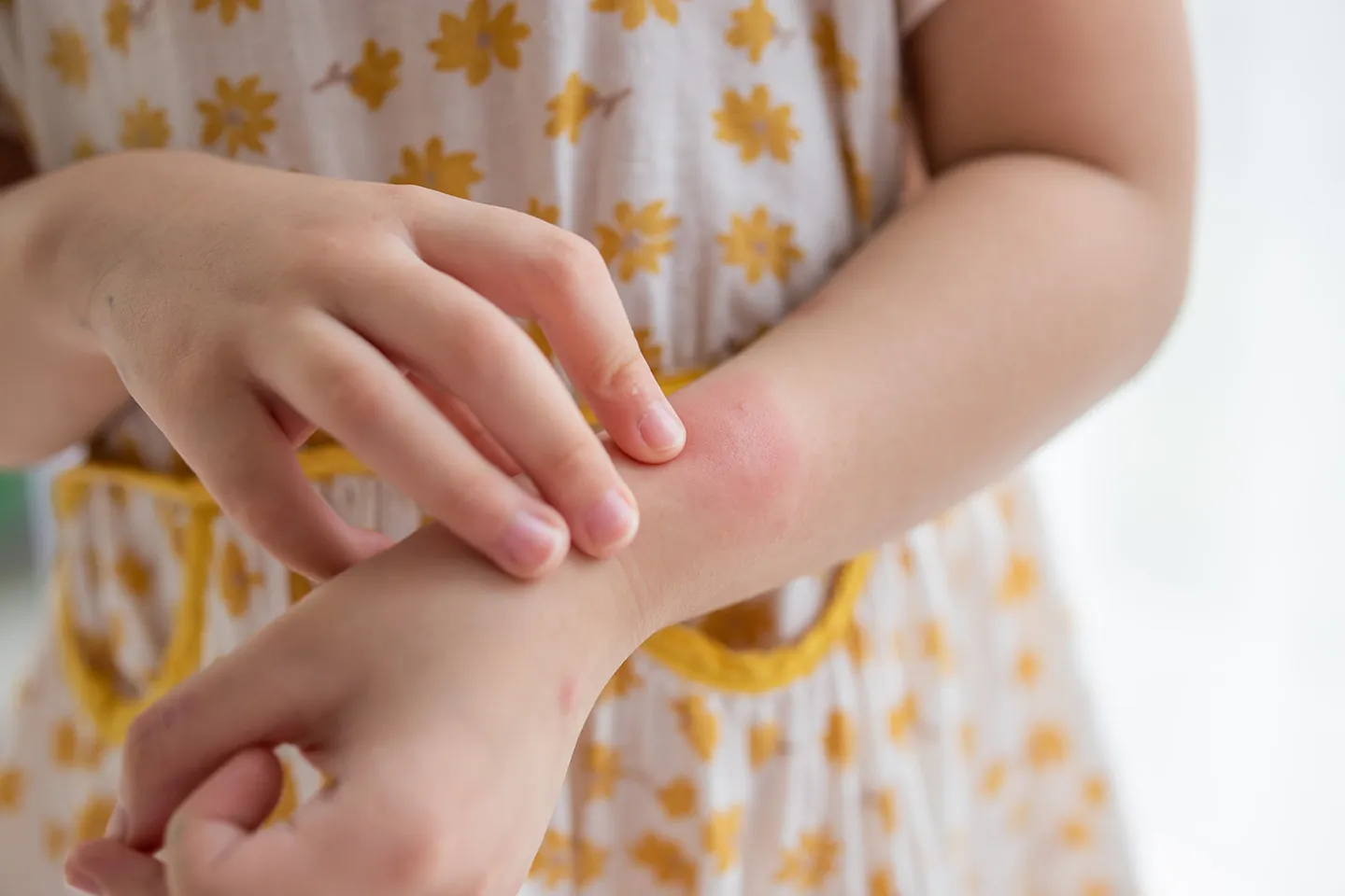 Pediatric dermatology myths about common children skin conditions
