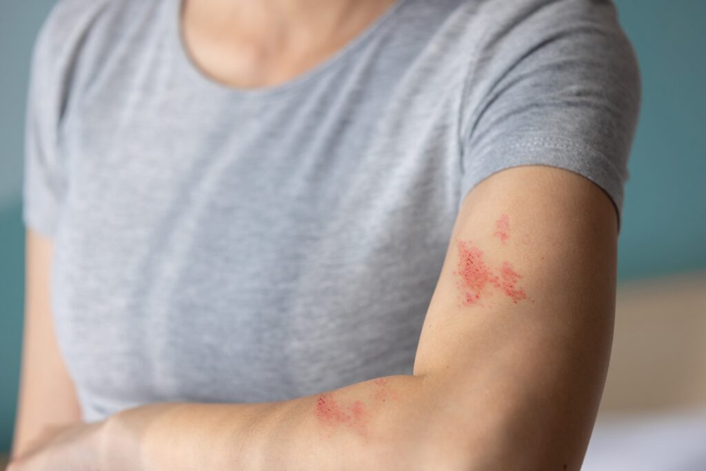 Skin infection types including fungal bacterial and viral