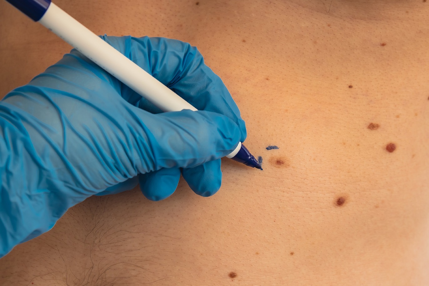 Mohs surgery patient journey from diagnosis to recovery