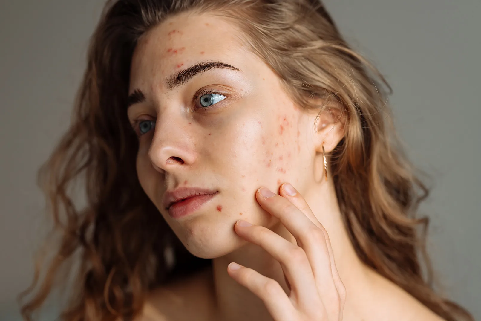 Stress and skin connection between mental health and skin flare-ups