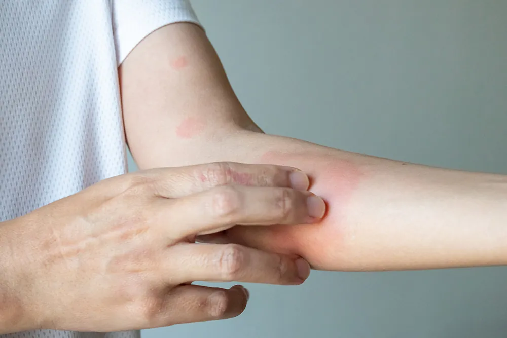 Psoriasis skin condition management strategies