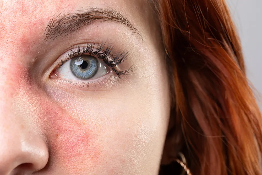 Rosacea facial redness causes symptoms and treatments
