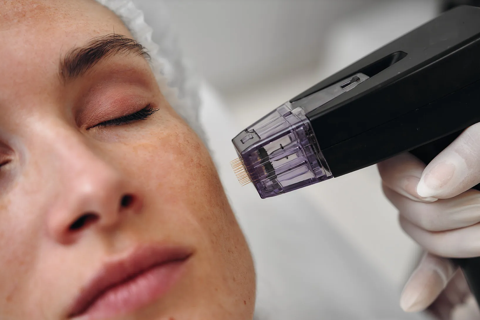 Collagen-boosting treatments comparing microneedling lasers and peels