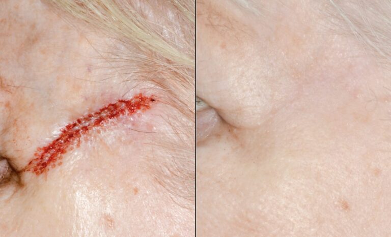 Mohs Surgery - Cheek SCC