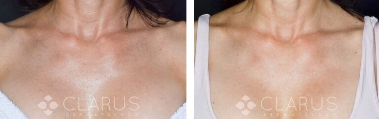 Dark Spot Treatment - Chest