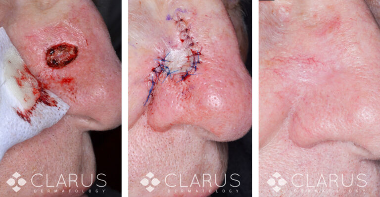 Mohs Surgery - Nose BCC