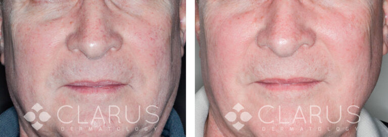 Blood Vessel Reduction
